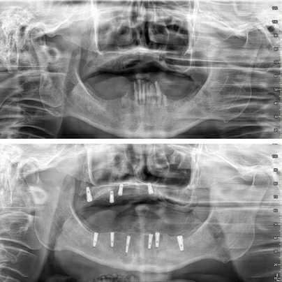 Tooth Extraction,Tooth,Surgical Extraction,Tooth Exraction Price,Tooth Exraction Cost,Implant,All On 4,All On 4 Implants,All On 4 Implants Cost,All On 4 Implant Dentures,All On 4 Implants Before And After,All On 6,All On 6 Implants,All On 6 Implants Cost,All On 6 Implants Turkey,All On 6 Images,Dentist,Dental Clinic,Alanya Dentist,Alanya Dental Clinic,Antalya Dentist,Antalya Dental Clinic,Turkey Dentist,Turkey Dental Clinic -