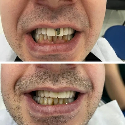 Zirconium Porcelain,Zirconium Porcelain Crowns,Zirconium Porcelain Veneers,Zirconium Porcelain Crowns/ Full Veneers,Zirconium Porcelain Crowns Turkey,Zirconium Porcelain Crowns Uk,Dental Treatment,Dentist,Alanya Dentist,Turkey Dentist,Zirconium Porcelain Price,Zirconium Porcelain Cost,The Top Zirconium Porcelain Apps,Zirconium Porcelain Crowns For A Strong,Natural-Looking Smile,Durable Zirconium Crowns For Long-Lasting Tooth Restoration,Zirconium Porcelain Crowns Vs. Traditional Crowns: Which Is Right For You?,Expert Zirconium Crowns Treatment From Experienced Dentists,Customized Zirconium Porcelain Crowns For A Perfect Fit,High-Quality Zirconium Crowns For A Beautiful Smile,Zirconium Crowns For Restoring Damaged Or Decayed Teeth,Strong,Aesthetically Pleasing Zirconium Porcelain Crowns,Affordable Zirconium Crowns Treatment Options,Get The Smile You Deserve With Zirconium Porcelain Crowns -