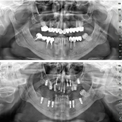 Tooth Extraction,Tooth,Surgical Extraction,Tooth Exraction Price,Tooth Exraction Cost,Implant,All On 4,All On 4 Implants,All On 4 Implants Cost,All On 4 Implant Dentures,All On 4 Implants Before And After,All On 6,All On 6 Implants,All On 6 Implants Cost,All On 6 Implants Turkey,All On 6 Images,Dentist,Dental Clinic,Alanya Dentist,Alanya Dental Clinic,Antalya Dentist,Antalya Dental Clinic,Turkey Dentist,Turkey Dental Clinic -