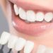 Learn About The Benefits And Care Of Metal Porcelain Crowns For A Stunning Smile. Trust Ovadent Dental Clinic Dental Clinic For Quality Care And Expert Advice.