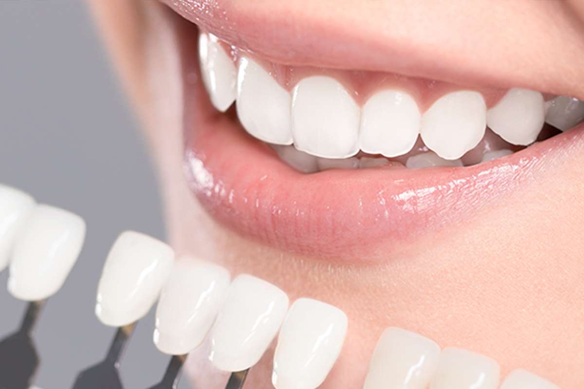 Metal Porcelain Crowns: Everything You Need to Know for a Dazzling Smile!