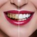 Transform Your Smile With Veneers! Learn About The Benefits, Cost, And Procedure Of This Cosmetic Dental Treatment. Contact Ovadent Dental Clinic For Expert Care And A Stunning Smile.