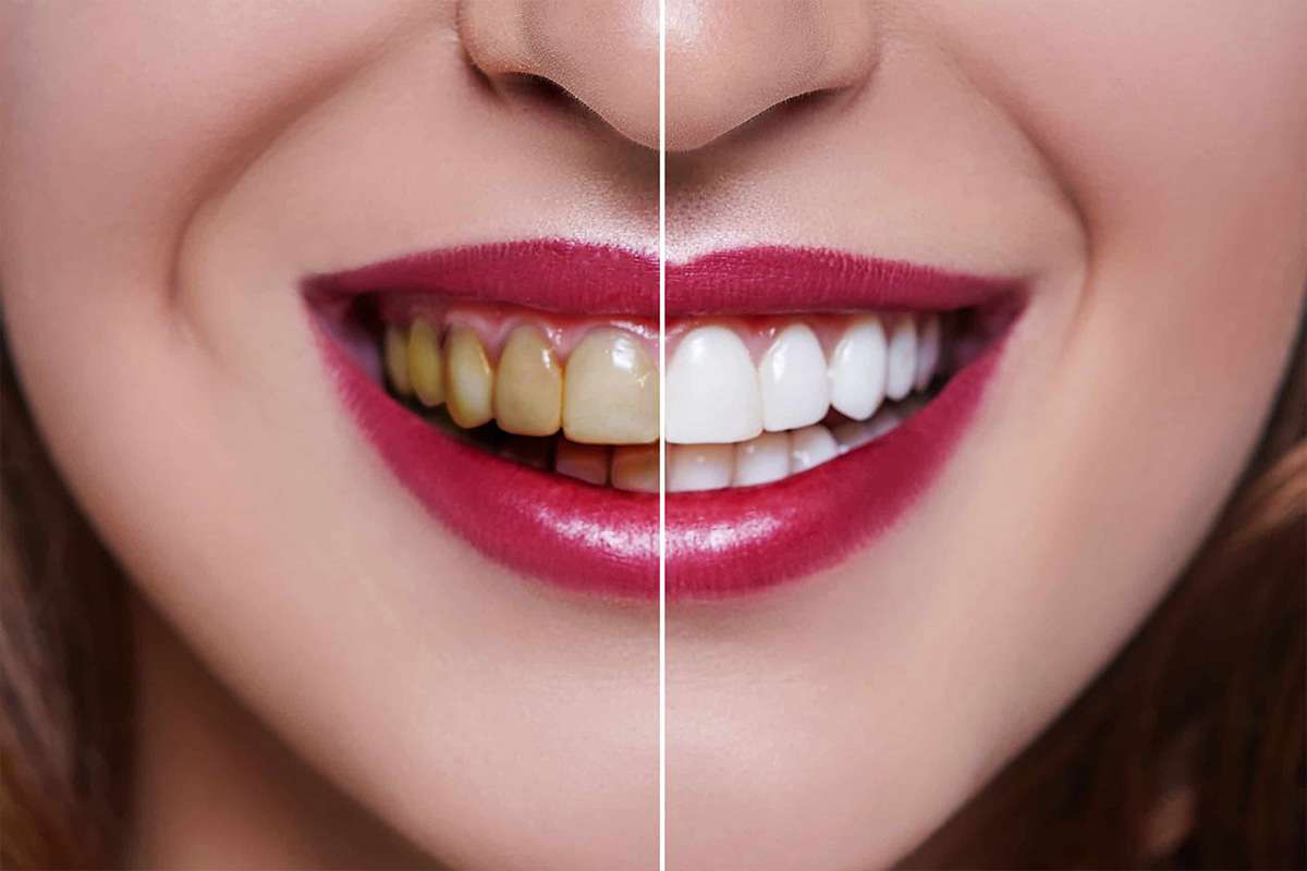 The Ultimate Guide to Veneers: Get the Perfect Smile with Ova Dental Clinic
