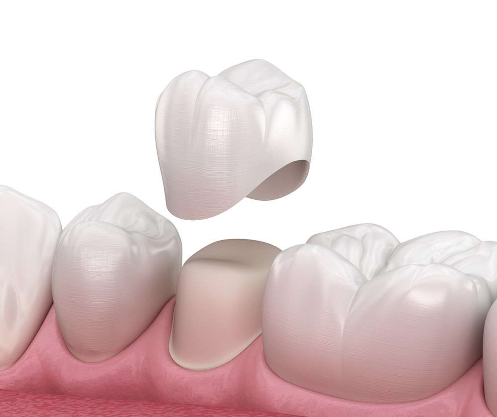 How To Care For Dental Crowns