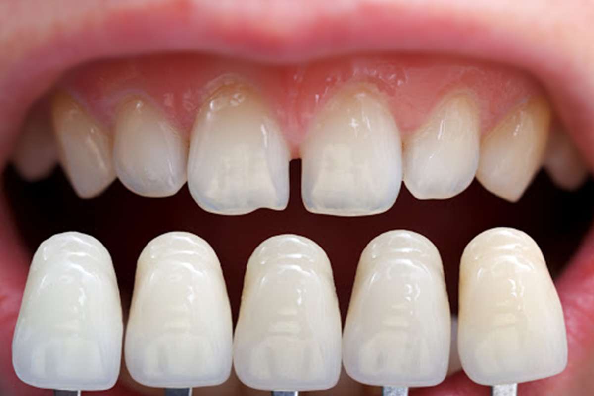 Understanding E-Max Crowns: What You Need to Know