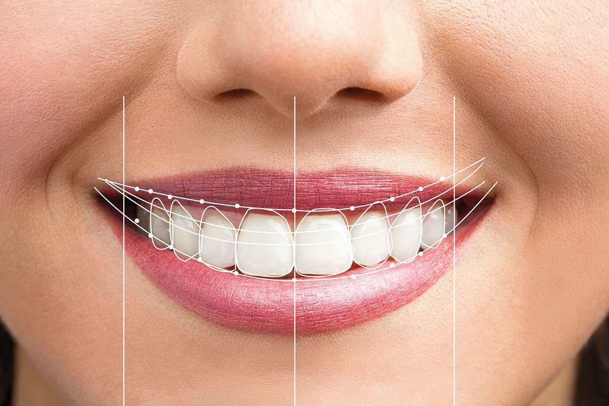 Transform Your Smile with Smile Design: A Step-by-Step Guide