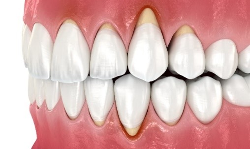 Gum Disease & Periodontology