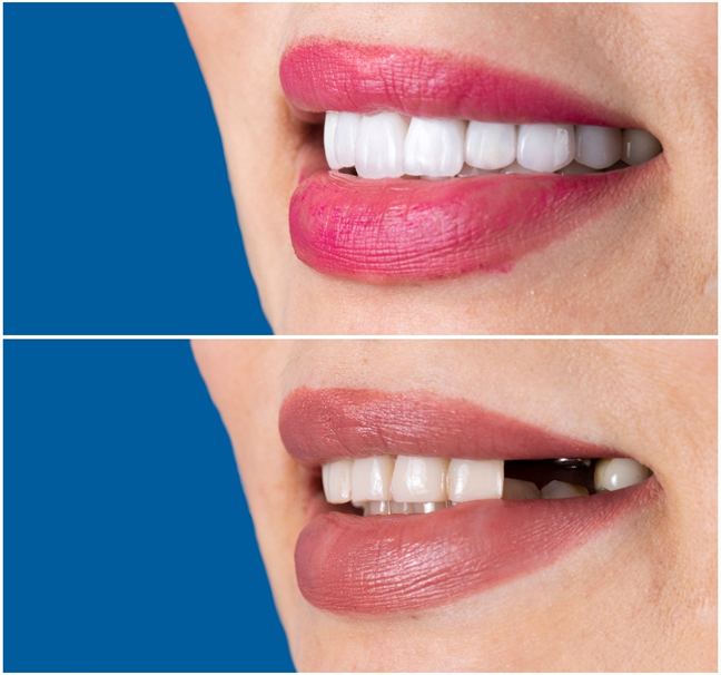 Restoring Smiles: The Unbeatable Power of Dental Implants