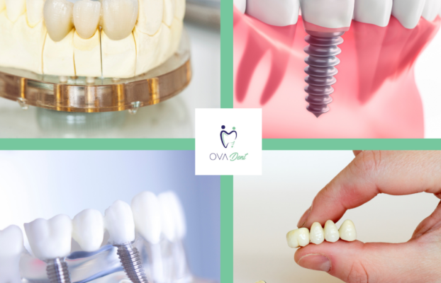 Unsure? – Dental Bridges Vs. Dental Implants: Which Is Perfect For You?