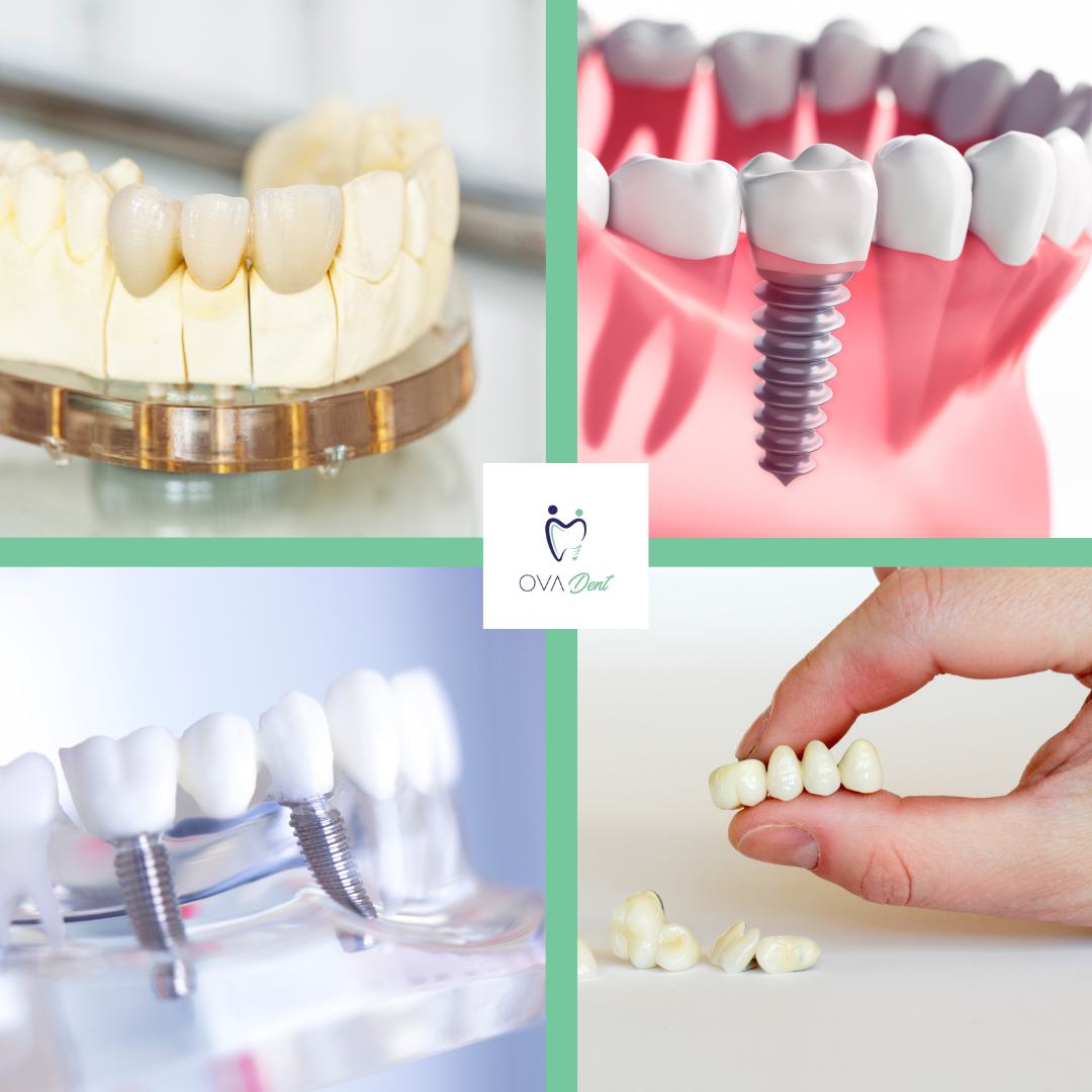 Unsure? – Dental Bridges vs. Dental Implants: Which is Perfect for You?