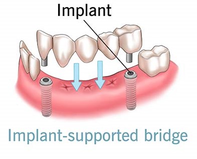 Dental Bridges -