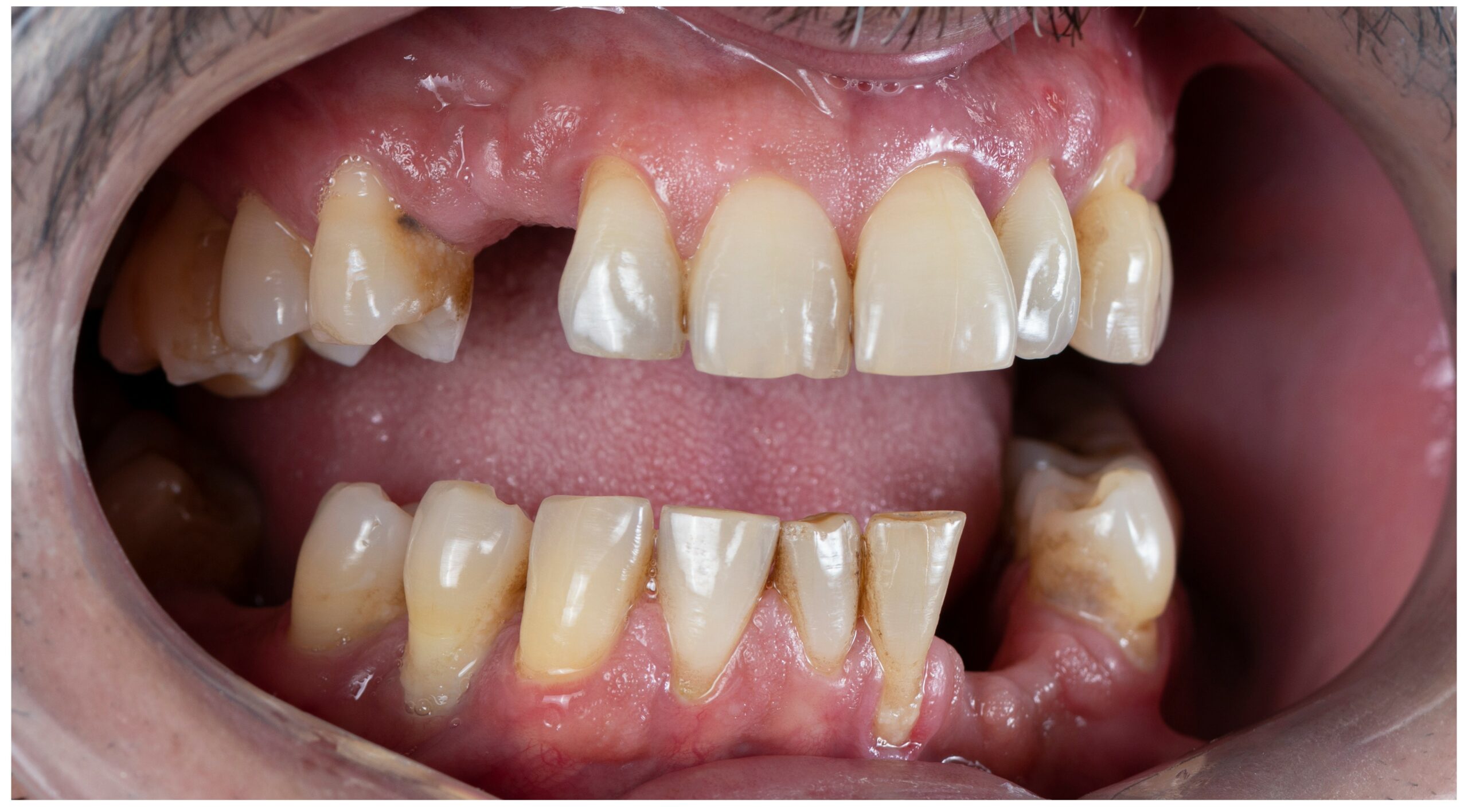 Selected Suitability: Transforming Smiles with Dental Bridges
