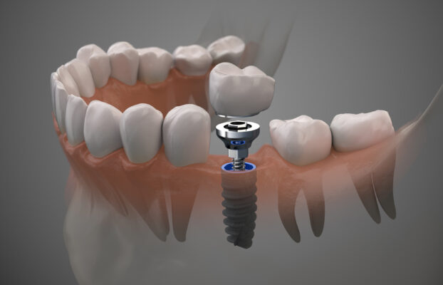 Perfect Smile: How Dental Implants Perfectly Emulate Natural Teeth
