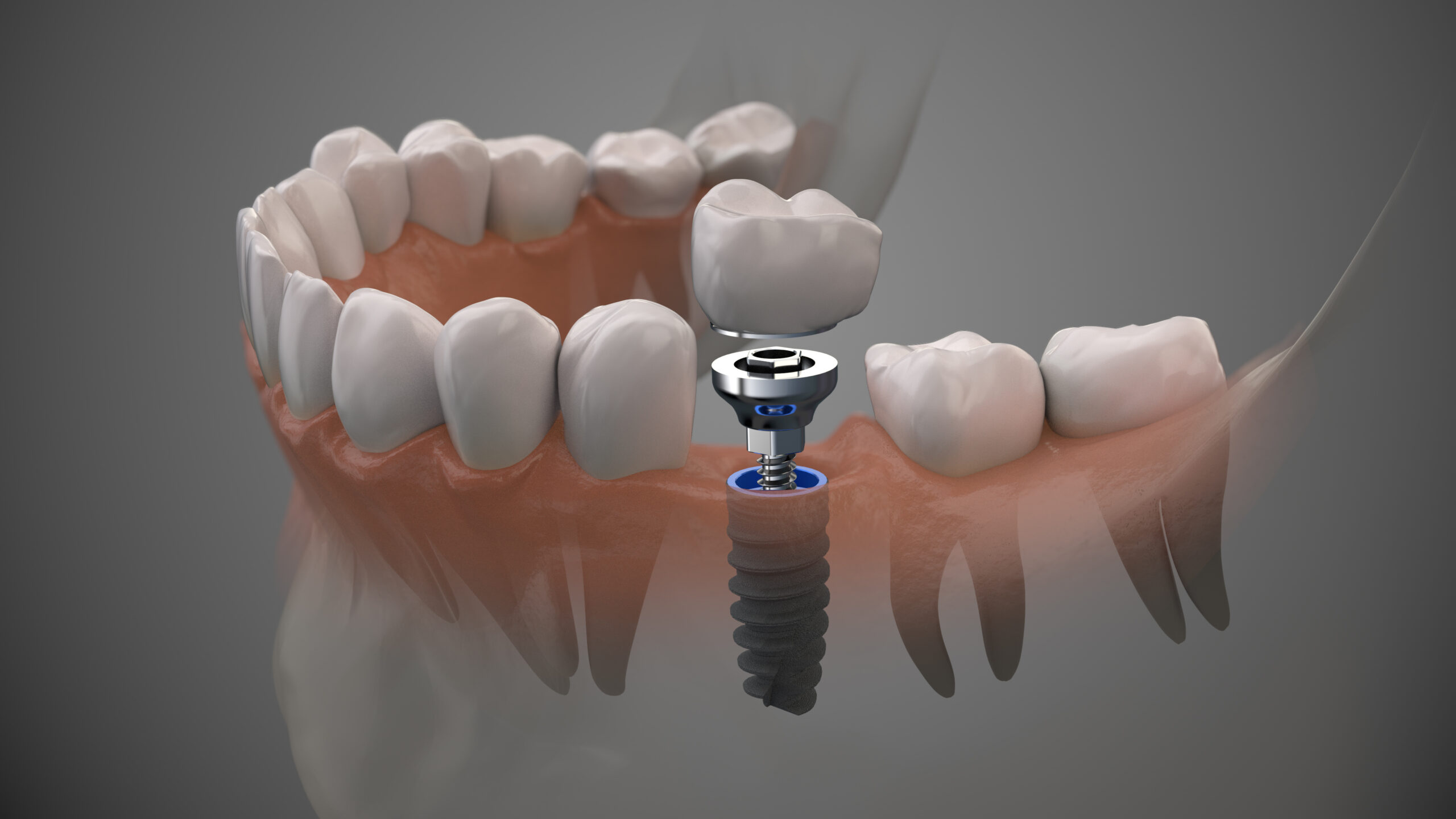 Perfect Smile: How Dental Implants Perfectly Emulate Natural Teeth