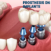 Revitalise Your Smile With Dental Implants