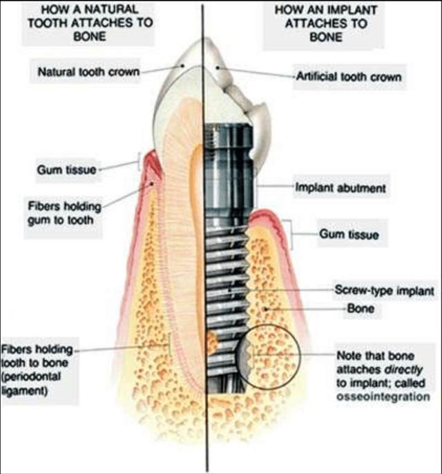 Fortifying,Dental Implants,Strength -