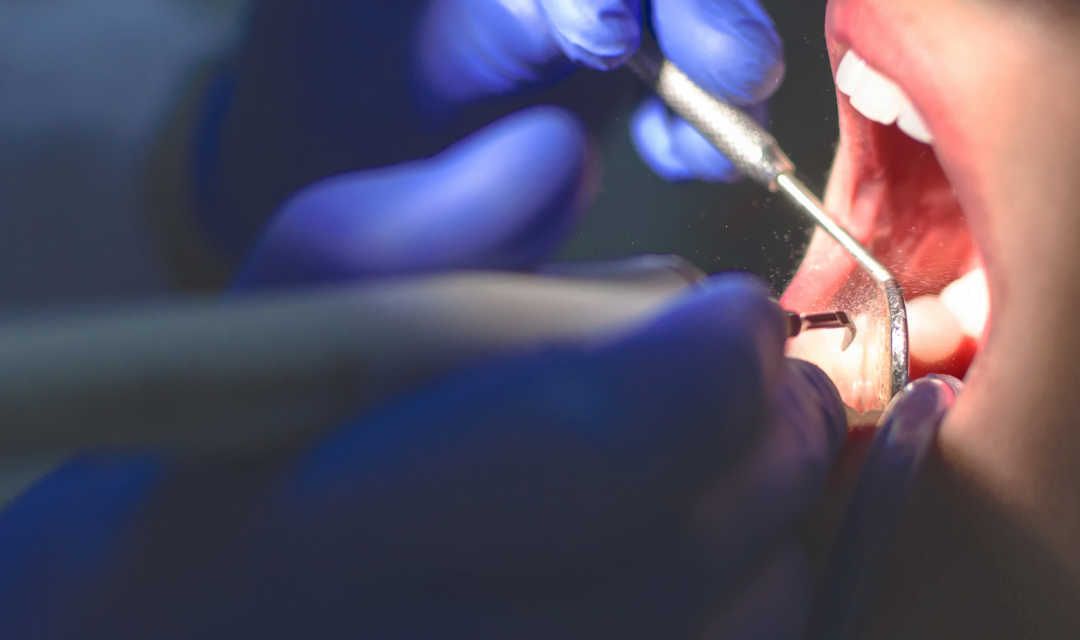 Alanya Teeth Braces at OVA Dent: Straighten Your Smile with Confidence