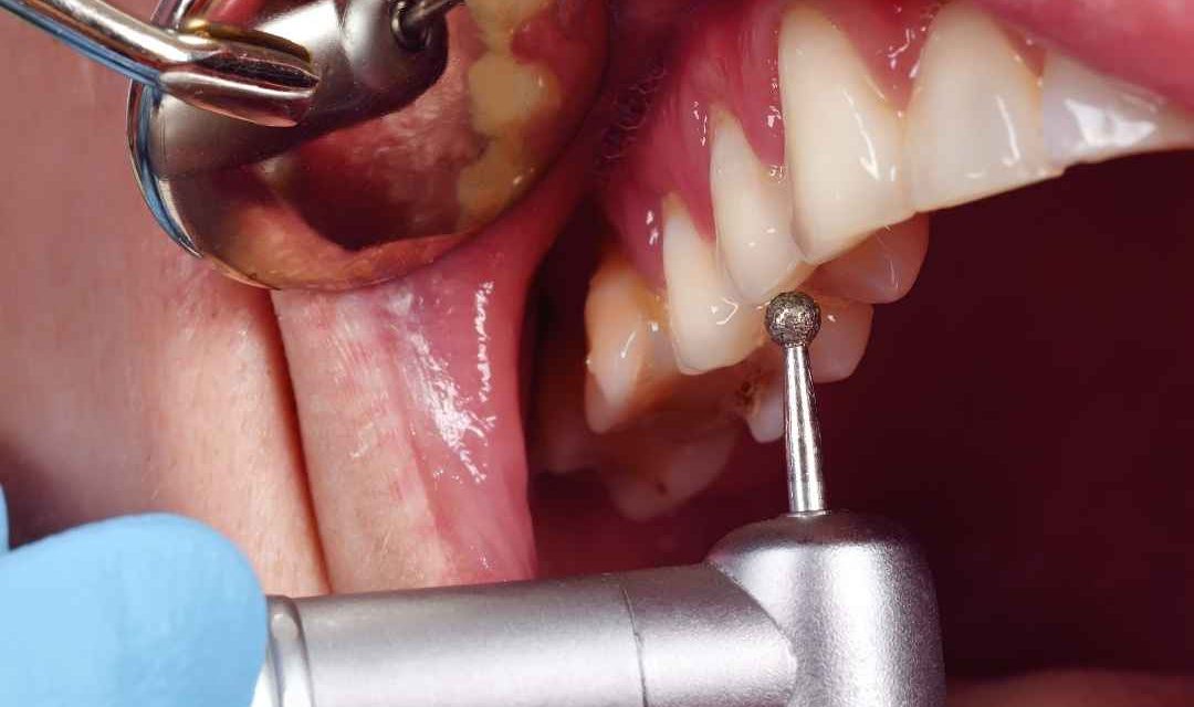 Alanya tooth bonding — Ova Dent